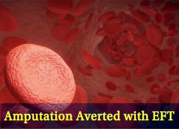 blood cells with blood cells flowing, clogged, amputation averted with eft